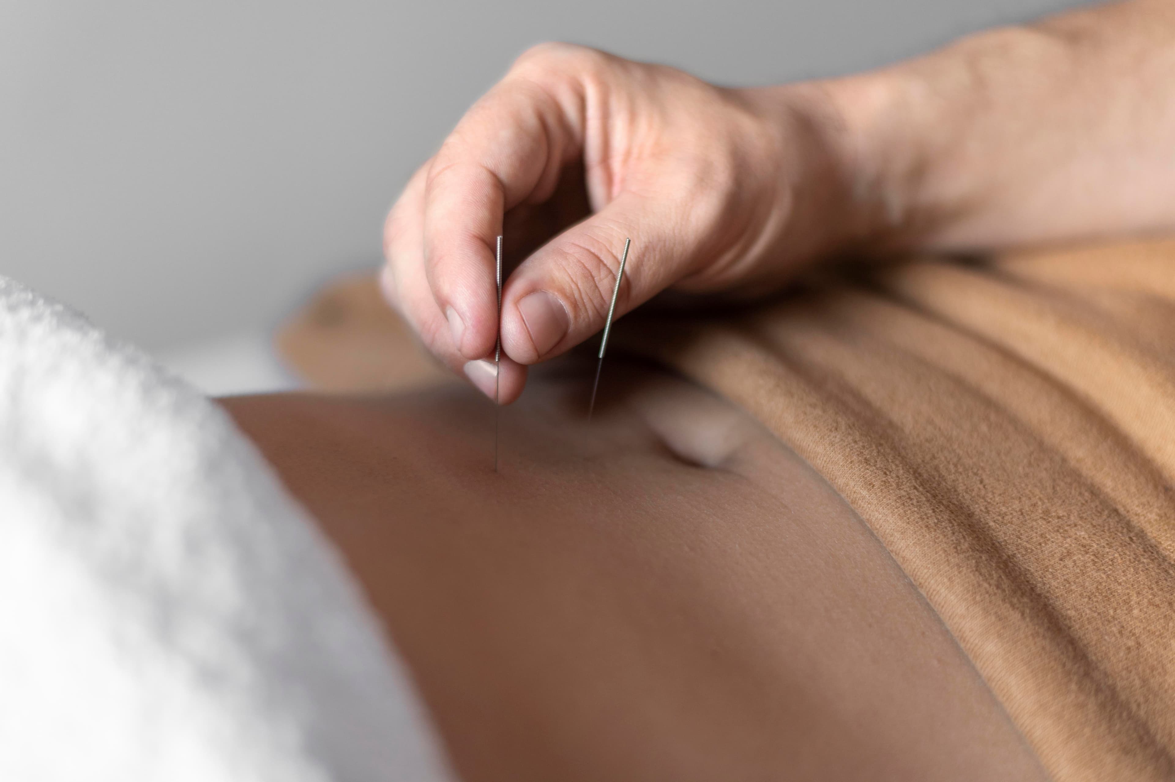 Acupuncture